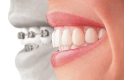 Aparelho dentário invisalign em Monsenhor Paulo